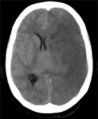 Case 1: CT scan brain plain done on 10th post op day showing LT ICA infarct