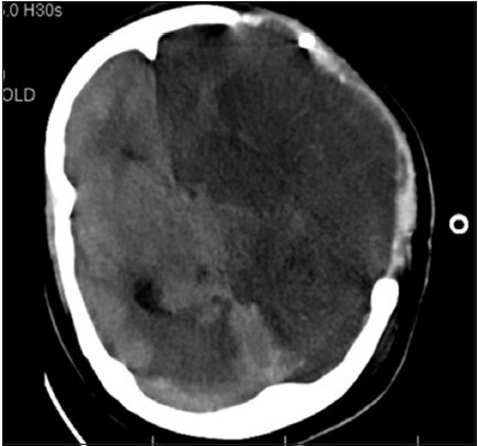 Case 1: CT scan brain plain after decompressive craniectomy showing established LT ICA infarct with evolving RT PCA infarct