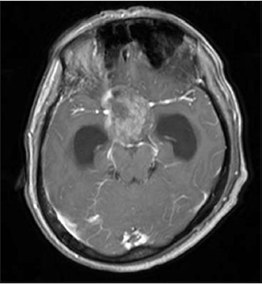 Case 2: MRI brain contrast axial section showing displacement of both ICA