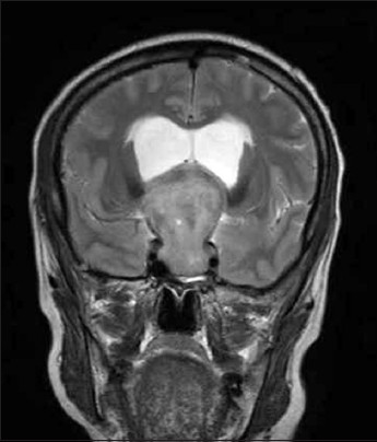 Case 2: MRI T2WI coronal section showing large tumor with supra-sellar extension to foramen of Monro with obstructive hydrocephalus and elevation of both ACA