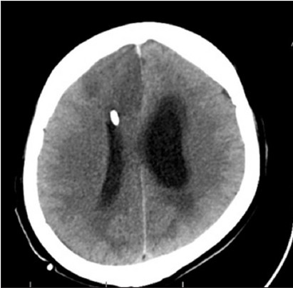 Case 2: Post-op CT scan on the second post-op day showing residual tumor with an increase in hydrocephalus and RT ACA infarct