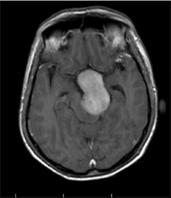 Case 3: MRI contrast axial section showing large pituitary adenoma with compression of LT cerebral peduncle