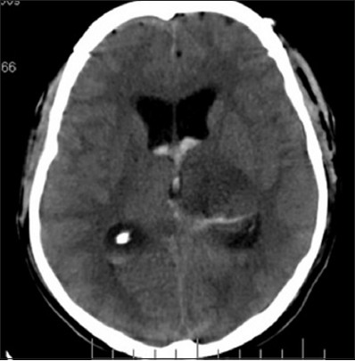 Case 3: Post op CT scan done on the fourth post-op day showing infarct in LT thalamus