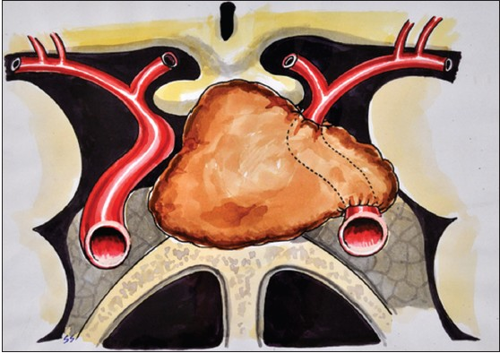 Artist's impression of encasement of ICA by tumor before surgery