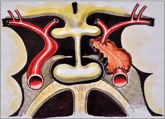 Artist's impression of strangulation of ICA by residual tumor after the surgery