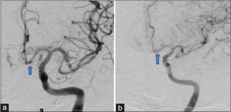 Digital subtraction angiography left internal carotid artery injection. (a) AP view: No definite aneurysm except for a double density shadow in distal A1 (arrow). (b) Oblique view which shows an aneurysm arising from the distal A1 (arrow)