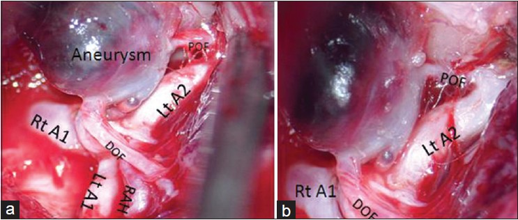 (a) Intraoperative picture. (b) Magnified view: Showing a partially thrombosed aneurysm arising from the orbitofrontal artery distal to its origin. DOF = Distal orbitofrontal artery, POF = Proximal orbitofrontal artery, RAH = Recurrent artery of Heubner, Rt = Right, Lt = Left