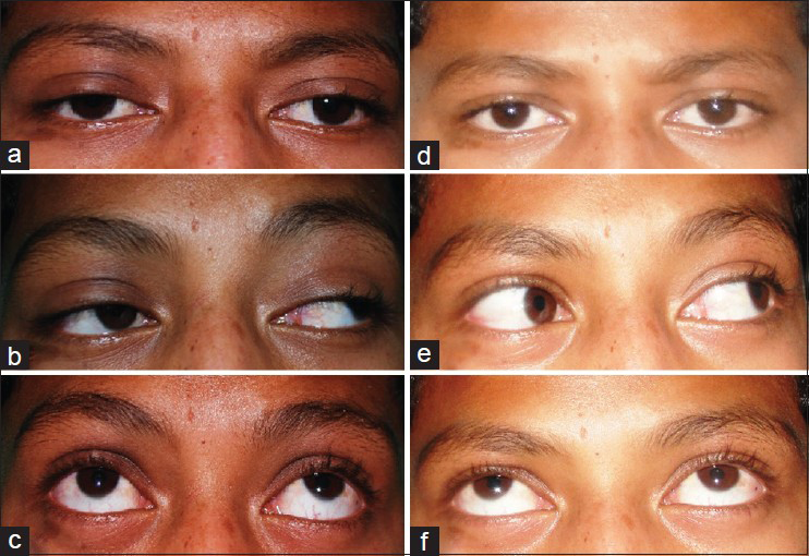 Isolated nuclear III nerve paresis secondary to neurocysticercosis ...