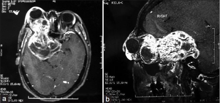 (a and b) Axial and sagittal MRI scan of brain and orbit showing a large well-marginated extra-axial middle cranial fossa mass with areas of cystic degeneration extending into the orbit