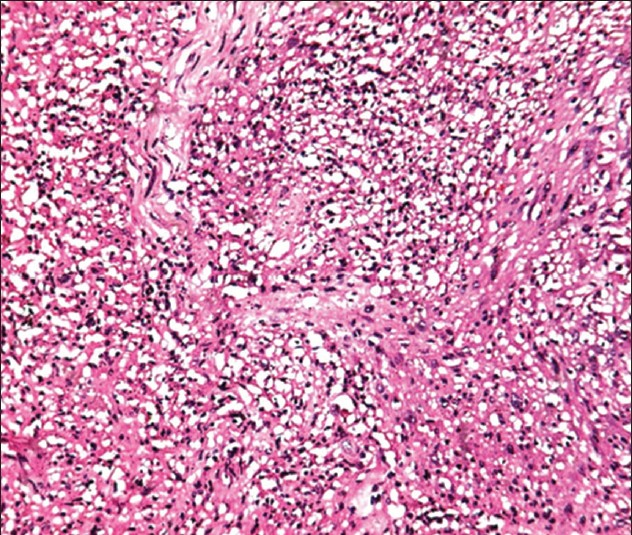 Histopathology showing neoplastic spindle cells arranged in fascicles and whorls (H and E stain, ×100)