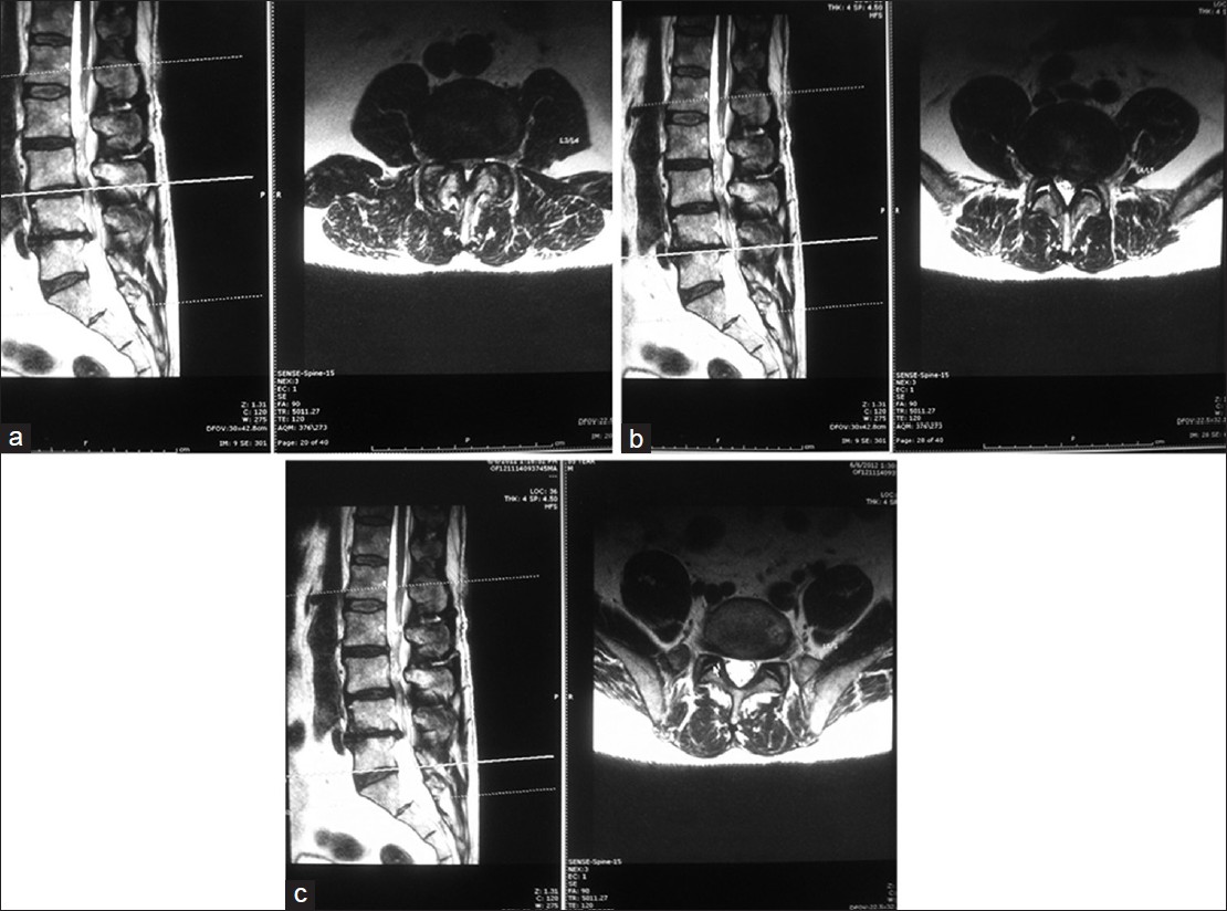 Successful Operative Management Of An Upper Lumbar Spinal Canal Stenosis Resulting In Multilevel 3800