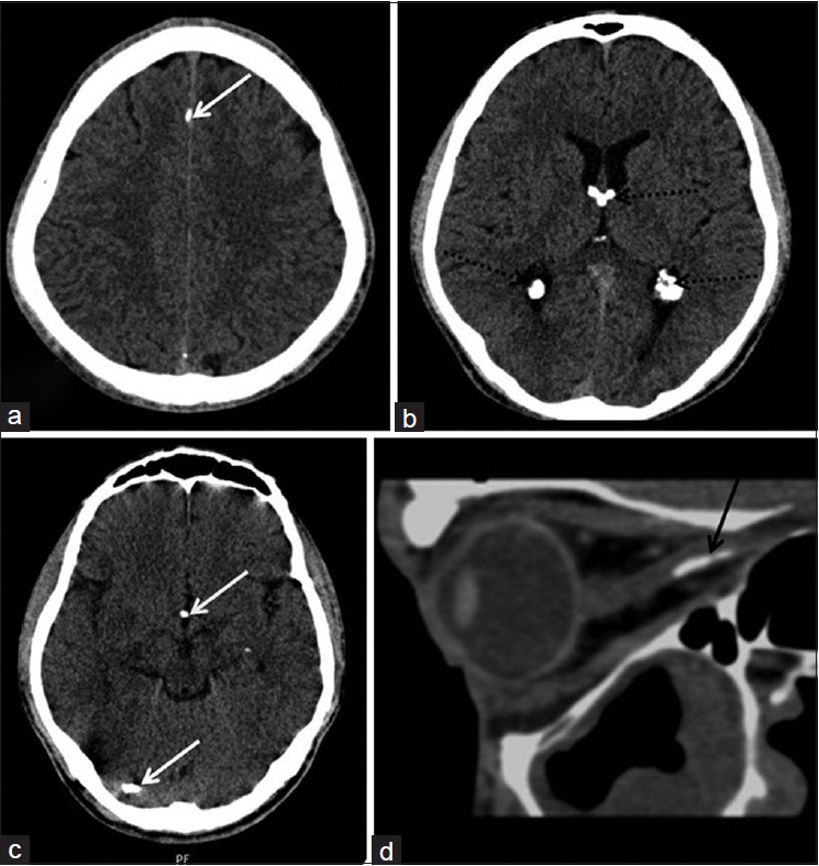 Axial plain CT sections (a-c) showing multiple small calcifications along falx, right tentorium, basal cistern (white arrows), subependymal locations along with bilateral choroid plexus calcifications (dotted black arrows). (d) Sagittal multiplanar reformatted CT image showingperipheral curvilinear calcification along optic nerve (black arrow)