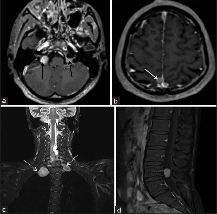 (a and b) Axial contrast MRI showing small vestibular schwannomas within bilateral acoustic canal (black arrows) and a posterior parafalcine meningioma (white arrow). (c) Coronal MR cervical spine image showing tumors in bilateral paraspinal location (dotted white arrow) and within the cervical spinal canal (dotted black arrow). (d) Sagittal post contrast images of lumbar spine showing enhancing intraspinal tumor (dotted black arrow)