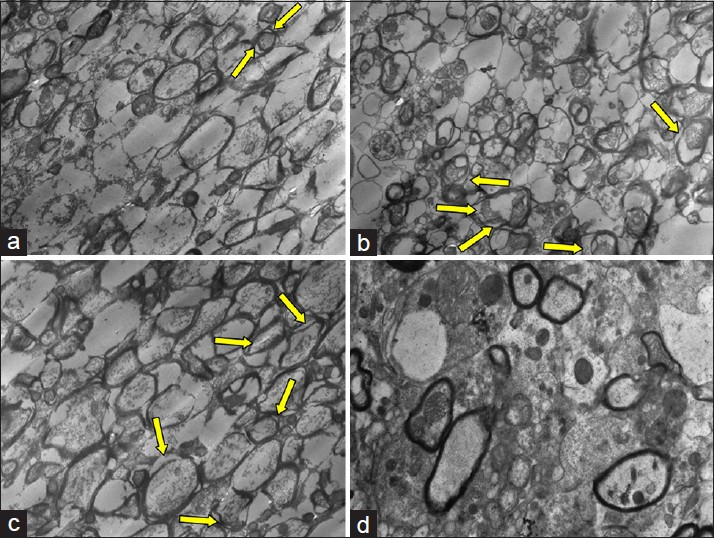 (a) Transitional electron microscopic (TEM) image of group 1 showed minimal detachment of myelin strata, arrow shows mitochondria. (b) Detachment of myelin strata (multiple arrows). (c) Similar ultrastructural alterations with prominent detachment of myelin strata (arrows). (d) Minimal ultrastructural alteration compared to findings of groups 2 and 3