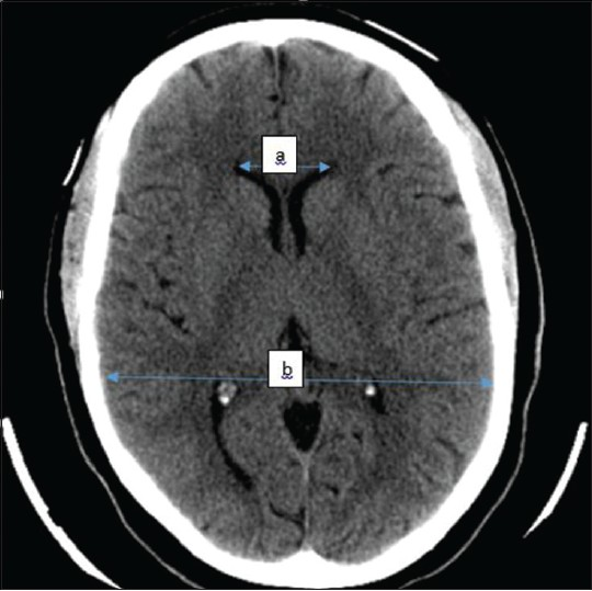 Illustrative axial CT section of one of the selected patients showing how measurements were taken Total anterior horn width (TAHW) =a Maximum intracranial diameter (MICD) =b