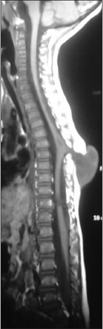 T1W MRI image showing the myelocystocele sac at D7-D10 level