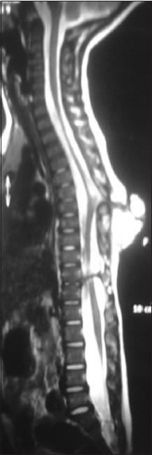 T2W MRI image showing hyperintense myelocystocele sac extending from D7-D10 level, with complete spur at D11 level, also noted is the syrinx at D6 level, low-lying tethered cord at L3 level