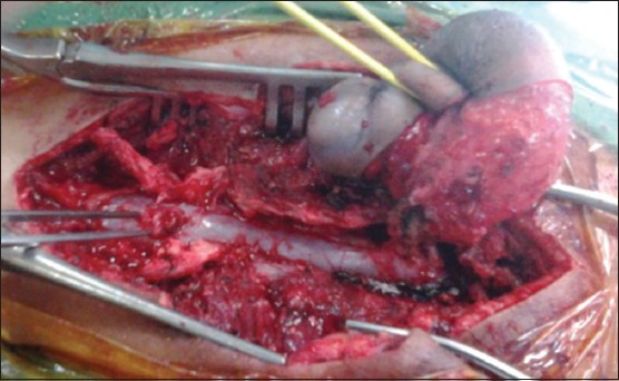 Operative photograph showing the nicely dissected myelocystocele sac and the bony spur