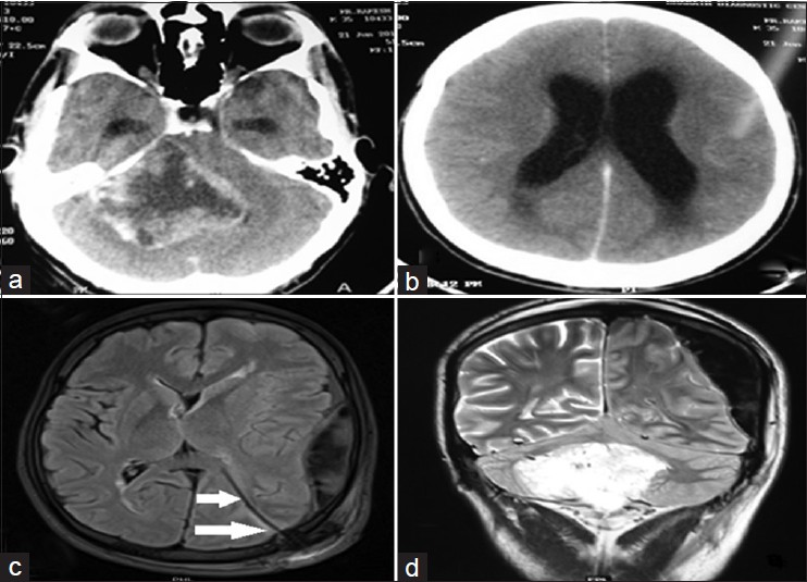 (a and b) Preoperative computed tomography scan showing heterogeneous mass lesion in the right cerebellar region extending to the brain stem at the pontine region with peripheral enhancement on contrast and obstructive hydrocephalus. (c) Postoperative MRI on day 3; EDH in the right temporoparietal region on T2‑weighted image along with the shunt tip in situ (arrows). (d) Postoperative MRI on day 3 showing hyperintense image in the right cerebellar region along with EDH