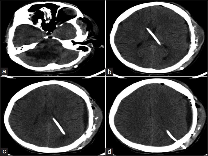 Postoperative plain computed tomography scan brain: (a) Plain CT scan brain showing the mass lesion in the right cerebellar region; (b-d) plain CT scan brain showing the evacuated hematoma with the shunt tube in situ