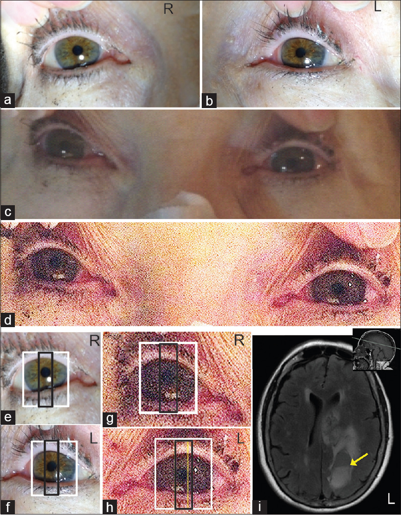 (a and b) Patients right (R) and left eye (L) imaged under bright light conditions;(c) unprocessed image of patients eyes imaged under dim light conditions;(d)image in C adjusted for brightness and contrast to highlight the pupillary margins in patients eyes.(e-h) Measurement of limbal and pupillary diameters of the R and L eyes imaged under bright (e and f) and dim (g and h) background illumination. The larger white box (e-h) represents the limbus diameter, which was equal in both eyes and measured 11.5 mm. The smaller black box represents the diameter of the pupil measured in the same axial plane as the larger white box. The yellow line in H represents the left edge of the patient's right pupil represented on the left eye. The distance between the yellow line in H and the right-edge of the black box in H represents the extent of anisocoria. There was a difference in PLD ratios of 0.0708 or 0.85 mm. (i) Fluid-Attenuated Inversion Recovery (FLAIR) MRI of brain showed large area of intra-axial parenchymal hemorrhage and surrounding T2 signal hyperintensity on the left. There was mass effect on the cingulate gyrus, corpus callosum and left lateral ventricle. Mild shift of the septum pellucidum to the right by approximately 8 mm was observed. Cystic area with fluid-fluid level (yellow arrow) is noted posteriorly in the left parietal region. Inset, sagittal T1-weighted image, the grey line indicates the axial plane illustrated in the FLAIR image