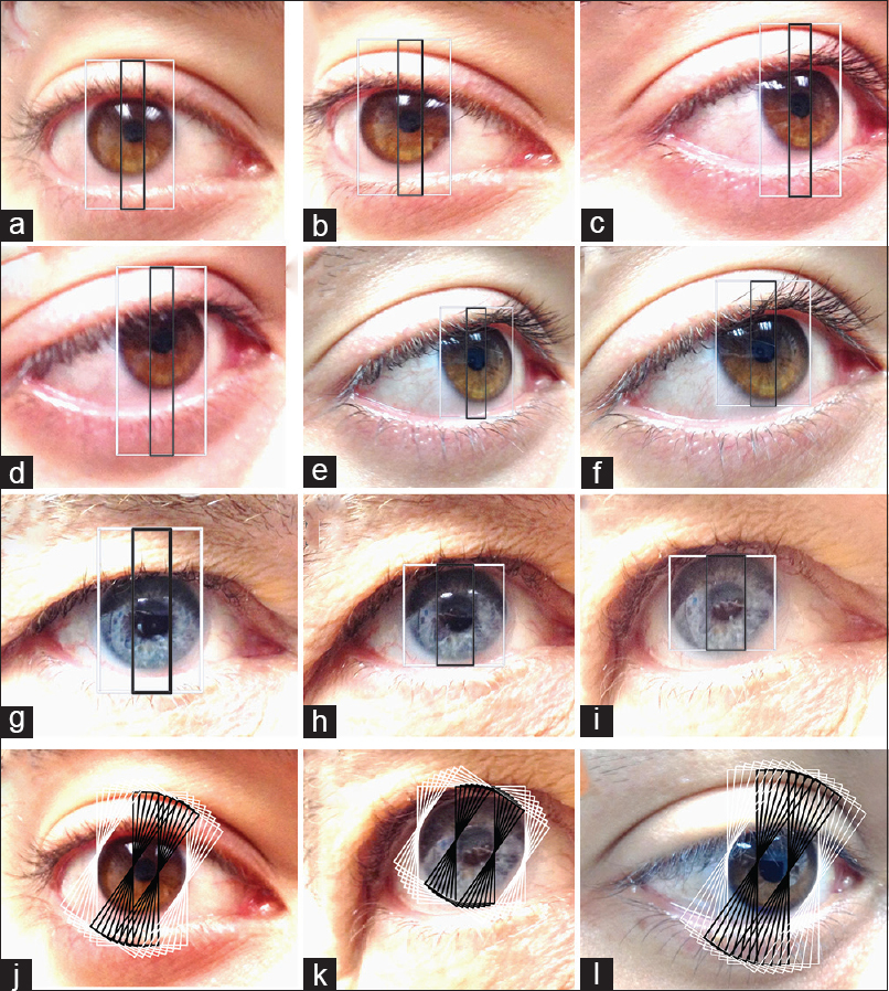 Examples of the images of three subjects (X,Y,Z): X: (a,b,c,d,e,f), Y (g,h,i) and Z (l) photographed from different angles and different distances. The PLD ratios were computed at para-horizontal axes. The width of larger outer (white) box represents an axial diameter of the limbus, whereas the smaller (black) box represents the axial pupillary diameter measured on the same axis as the limbus. The pupil to limbal diameter (PLD) ratios for ninerandom perspectives tested for the subjects X and Y were 0.263 (±S.E.M 0.0004) and 0.307 (±S.E.M 0.0007), respectively. The pupillary sizes on frontal view were X: 3.024 mm (A,B,C,D,E,F) and Y: 3.53 mm (G,H,I). PLD ratios measured in sample ocular images of subjects X,Y and Z (X:j, Y:k, Z:l) at different para-horizontal axes (eight paired boxes (black + white) each at 5 degree increments over¬ 35 degrees). The PLD ratios for X, Y and Z for eightpaired PLD measurements (for every 5 degree difference in orientation across 35 degrees) across siximages each were X: 0.263 (±S.E.M 0.0003), Y: 0.307 (±S.E.M 0.0005) and Z: 0.362 (±S.E.M 0.0005)