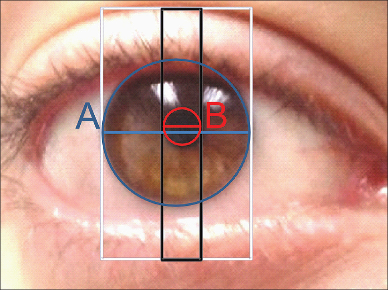 The box method for estimation of PLD ratios measures limbal diameter (A, blue diameter) and pupil diameter (B, red diameter) pupillary sizes at parallel axes and not always the same axes. The separation between the two diameters is proportional to the pupillary eccentricity