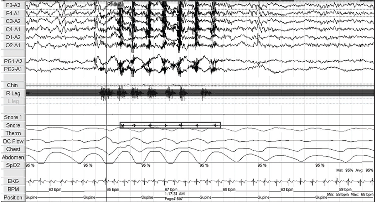 Polysomnography findings in sleep-related bruxism. Limb Movement (Right leg) preceding the RMMA by 1 second and associated with micro-arousal (EEG), grinding sounds (Snore), normal airflow and increase in heart rate (BPM)