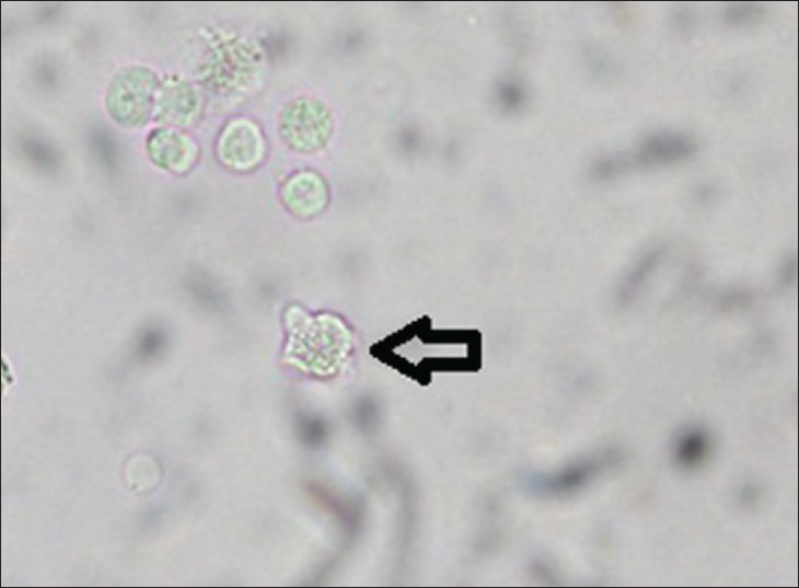 Trophozoite of Naegleria fowleri seen during direct microscopy (indicated by arrow)