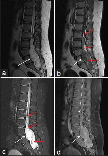 Pre-operative MR images of the lumbosacral spine show the presence of an intraspinal cystic lesion causing scalloping of the posterior aspects of bodies of L4, L5 and S1 vertebrae. It is heterogeneously hyperintense on T2 [as shown with white arrows in figure 1a], hypointense on T1 [Figure 1b], hyperintense on STIR [Figure 1c] and shows heterogeneous post contrast enhancement [Figure 1d]. There is presence of fat component in the lesion which is hyperintense on T1 and suppressed on STIR (as shown with red arrows in Figure 1b and c)