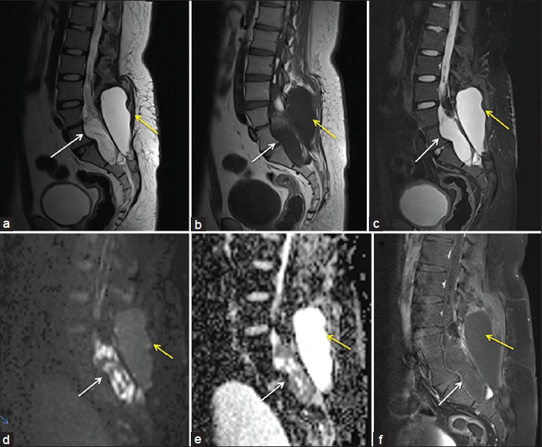 MRI of the lumbosacral region shows presence of an intraspinal cystic lesion causing scalloping on the posterior aspects of bodies of L5 and S1 vertebra. It is heterogeneously hyperintense on T2), hypointense on T1-weighted images and hyperintense on STIR (as shown with white arrows in Figures 2a, b and 2c, respectively). It shows restricted diffusion (white arrows in Figure 2d and e) and peripheral enhancement in post contrast images (white arrow in Figure 2f). The cauda equina nerve roots cannot be seen separately in this region and there is syrinx formation in the scanned spinal cord [Figure 2a]. There is presence of another cystic lesion in the paraspinal region which is not showing any restricted diffusion which is postoperative collection (as shown with yellow arrows in the figures)