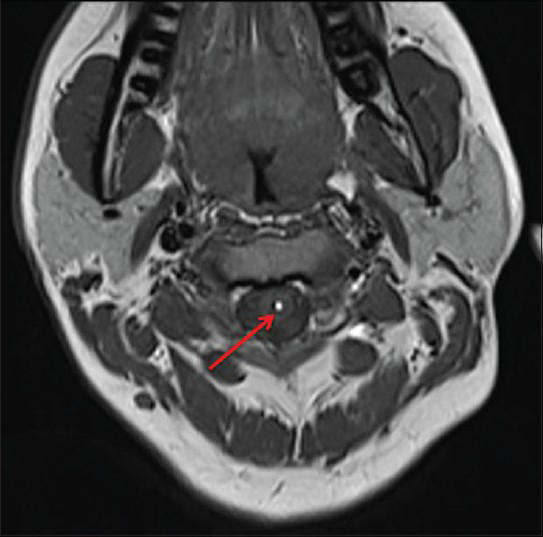 Axial MRI T1-weighted image shows seedling along the central canal of spinal cord