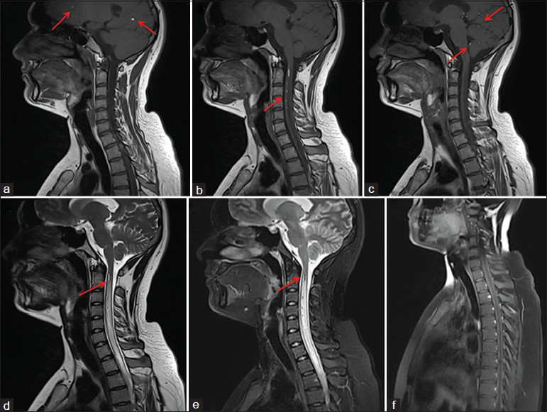 MRI of the cervical spine shows presence of altered signal intensity foci in the lateral ventricle, central canal of the spinal cord, fourth ventricle, cisterns and along the sulci, which are hyperintense on T1-weighted images (as shown with red arrows in Figure 4a–c), hyperintense on T2 [Figure 4d], suppressed on STIR [Figure 4e] and no post contrast enhancement [Figure 4f]. There is also formation of syrinx [Figure 4d and e]