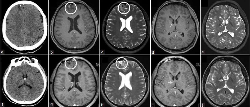 (a) Non-contrast brain CT, axial section, showing a hypodense lesion with a small focus of calcification in the right frontal lobe. This is neurocysticercosis, and the calcified focus represents the scolex of the cysticercus. Brain MRI (b) T1-weighted post-contrast and (c) T2-weighted, axial sections at the level of the right frontal intraparenchymal neurocysticercosis lesion shows a ring-enhancing mass, measuring 6 × 7 mm in size, with perilesional edema in the surrounding anterior medial frontal lobe (circle). Brain MRI (d) T1-weighted post-contrast and (e) T2-weighted, axial sections at the level of the anterior third ventricular lesion shows a non-enhancing mass most consistent with a colloid cyst (arrow). (f) Non-contrast brain CT, axial section, showing a hyperdense lesion in the anterior third ventricle without evidence of obstructive hydrocephalus. This is the typical appearance of a colloid cyst on CT. Post-operative brain MRI performed 3 months following craniotomy for resection of the right frontal cysticercus. (g) T1-weighted post-contrast and (h) T2-weighted axial sections at the level of the evacuated neurocysticercosis lesion shows post-operative changes of a craniotomy without evidence of residual or recurrent infection (circle). (i) T1-weighted post-contrast and (j) T2-weighted axial sections at the level of the third ventricular lesion shows unchanged appearance of the mass presumed to be a colloid cyst (arrow).