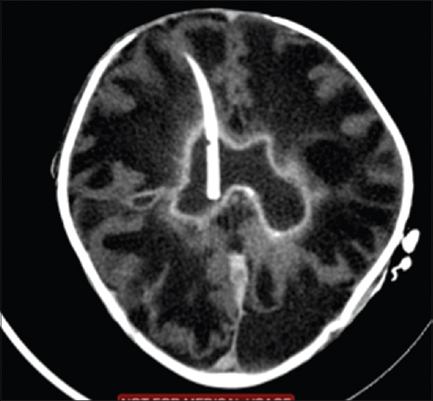 External ventricular drain in the ventricle draining infected cerebrospinal fluid