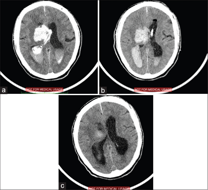 (a) Preoperative image showing intracerebral hemorrhage (ICH) and intraventricular hemorrhage (IVH) (b) Image immediately after external ventricular drain (EVD) insertion. Tube is in the left ventricle (c) computed tomography of the same patient after 2 weeks post ICH/IVH and EVD