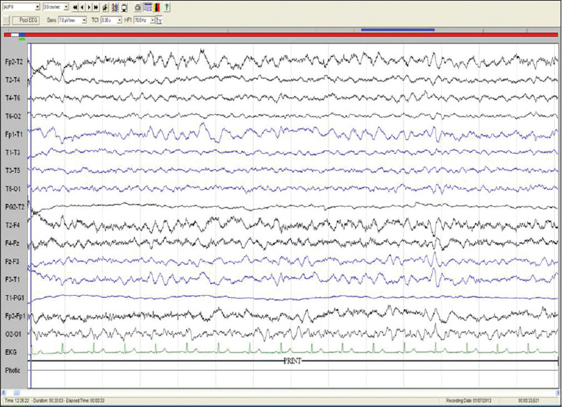 Electroencephalography of patient no. 7: Bipolar longitudinal montage (sensitivity 7.5 μV/mm, low frequency filter 1 Hz, high frequency filter 70 Hz, notch, 50 HZ, speed 30 mm/s) showing diffuse slowing of background rhythm (frequency: 3–5 Hz)