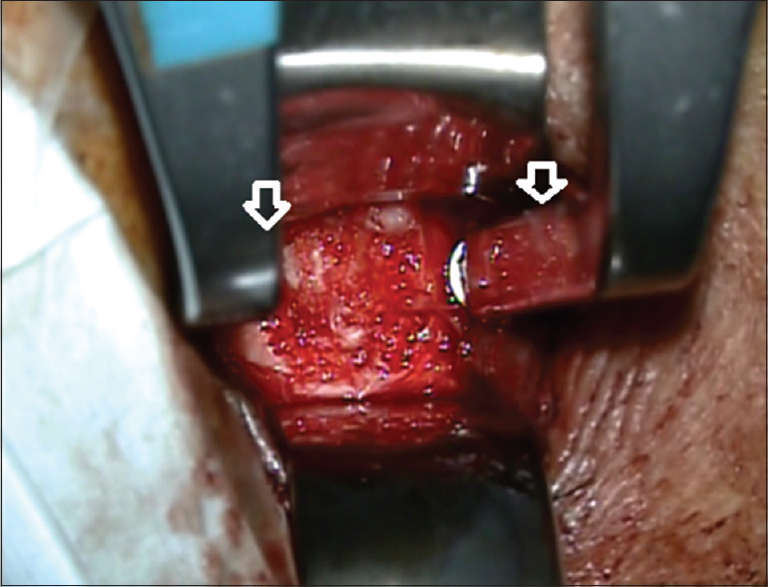 Anterior cervical approach without fixed automatic retractors, note the use of lateral protective (vascular bundle) and medial support of lever arms fixing vertebral spacer screws (a). The intersomatic space and microscope visibility are acceptable