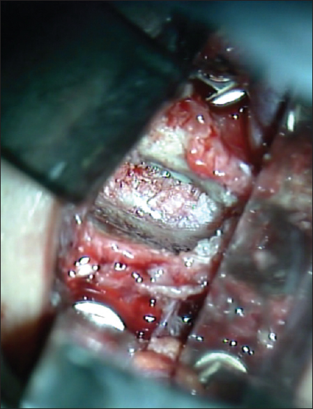 The approach allows deep plane maneuvering with instruments. Is evident the microsurgical view of anatomical structures as the posterior longitudinal ligament, uncinate apophysis and interbody platforms