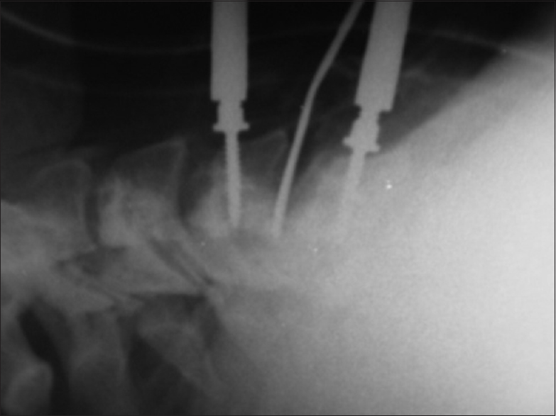 Image of the reach of the instruments through intra-operative fluoroscopy, with no evidence of automatic retractors. Note the effect of the milling on the edge of bone spurs, as evidence that deep access is possible without the need for automatic separators