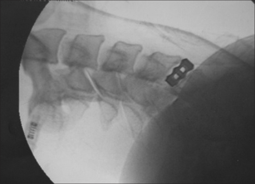 Position of the interbody titanium implant is shown in position at a supraselective space