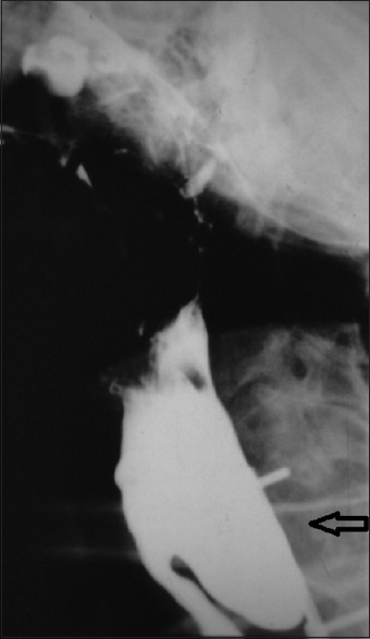 Diverticulum esophagicus as a cause of dysphagia, developed after trauma brought about by the use of mechanical fixed retractors that weakened the wall. In this case, it required surgery for esophageal repair in a second surgical procedure