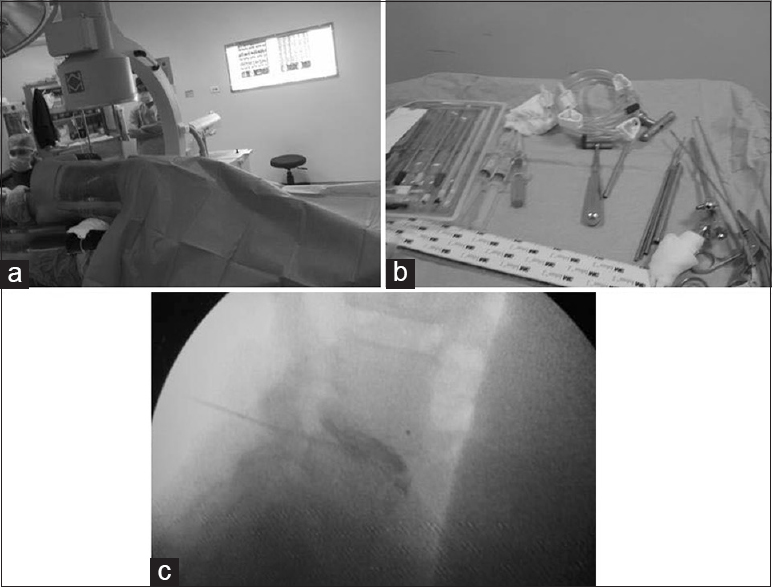 Preoperative positioning of the patients (a) and endoscopic equipment (b) with intraoperative discography (c)