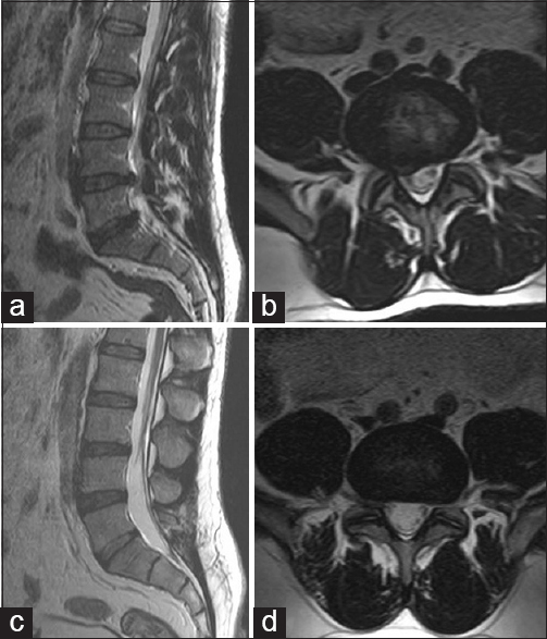 Preoperative sagittal (a) and axial T2-weighted magnetic resonance (MR) images (b) showing a right L4-5 lumbar disc herniation. Postoperative 1-year follow-up sagittal (c) and axial T2-weighted MR images (d)