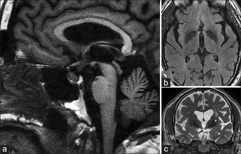 (a) Sagittal T1-weighted magnetic resonance imaging (MRI) in the midline showing normal sellar and suprasellar structures. There is mild thickening of the pituitary stalk but no evidence of a mass (this thickening was appreciated 7 months later in retrospect). (b) Fluid attenuation inversion recovery image just rostral to the chiasm and optic nerves showing no lesions in or around anterior third ventricle. (c) A coronal T2-weighted MRI at the level of the basilar artery (arrow) just posterior to the chiasm showing no evidence of a mass (a = left; b = upper right; c = lower right)