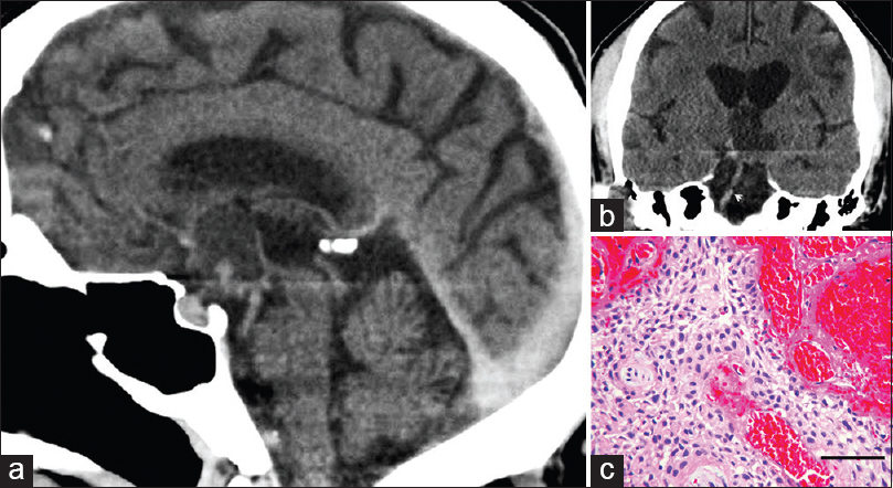 (a) Computed tomogram 7 months after magnetic resonance imaging study shown in Figure 1. Sagittal reconstruction shows cystic mass (arrows) in the suprasellar cistern. (b) Coronal reconstruction at the level of the basilar artery (arrow) demonstrates cystic mass. The lesion is slightly hyperdense to cerebral spinal fluid in the third ventricle. (c) Microscopic examination of the partially removed tumor demonstrated sheets of squamous epithelium with peripheral palisading and intervening fibrovascular connective tissue. No mitotic figures were seen (H and E, bar = 80 microns) (a = left; b = upper right; c = lower right)