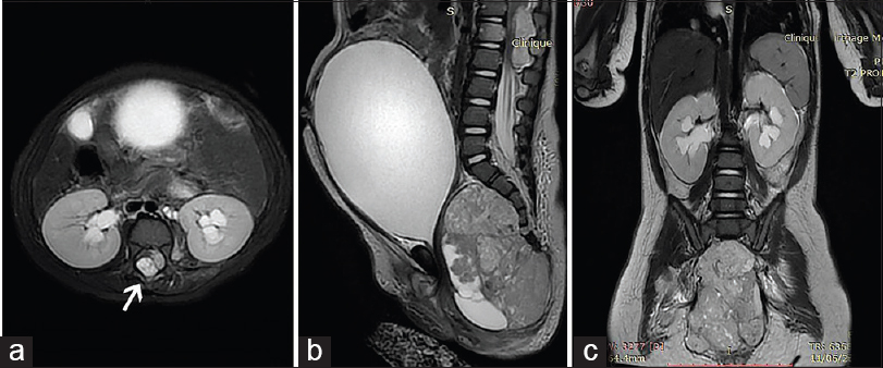 T2-weighted magnetic resonance imaging in axial (a), sagittal (b) and coronal (c) views showing a huge tumor mass arising from the sacrococcygeal junction; occupying the pelvis, and reaching the subcutaneous tissue (the associated epidural metastatic location at the level of L1 causing important thecal sac compression [arrow])