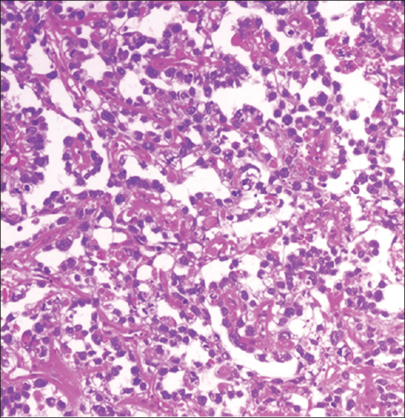 Photomicrograph of the tumor specimen showing typical features of yolk sac tumor with Schiller–Duval bodies (H and E, original magnification ×100)