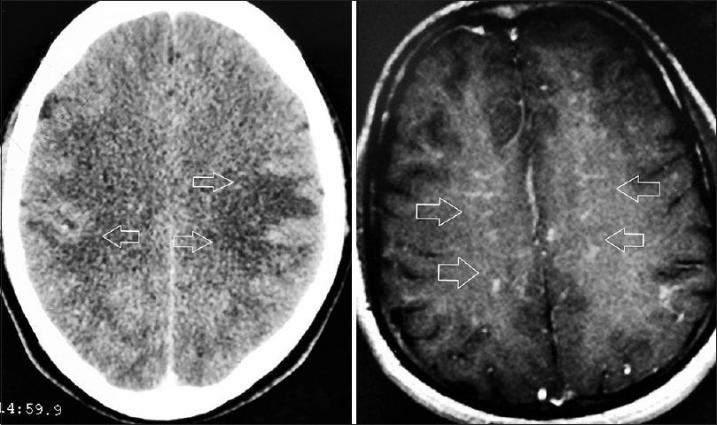 Bilateral frontal and parietal hypodensities (arrows) seen on brain CT scan (Contrast enhanced) on the left. These appear as iso or hypointese lesions exhibiting speckled enhancement on MRI brain (with gadolinium enhancement)