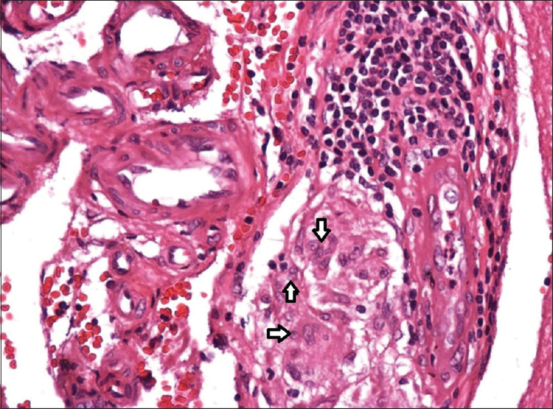 Histopathological appearance of brain/meningeal biopsy showing giant cells and mononuclear cell infiltration of vessel walls in the meninges (H and E stain)